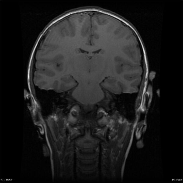 File:Neurofibromatosis type 1 (Radiopaedia 22541-22564 Coronal T1 32).jpg