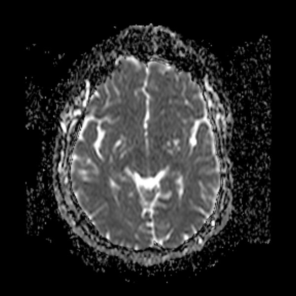 File:Neurofibromatosis type 2 (Radiopaedia 67470-76871 Axial ADC 11).jpg