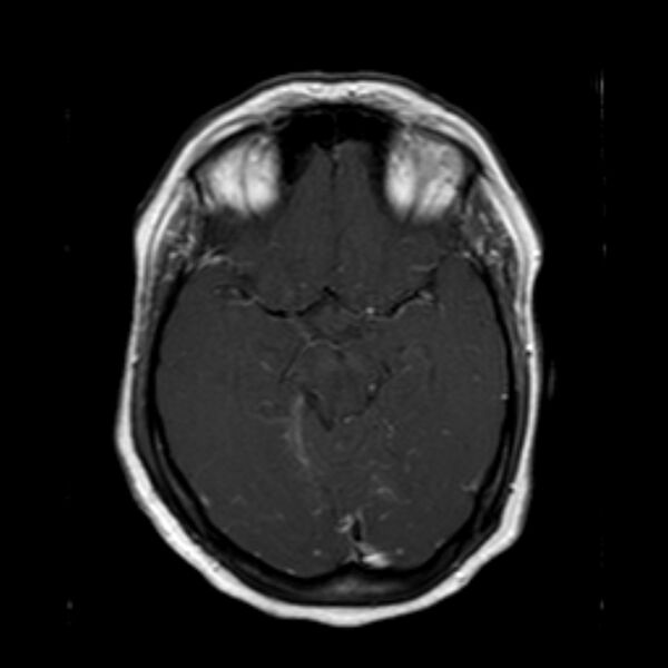File:Neurofibromatosis type 2 (Radiopaedia 67470-76871 Axial T1 C+ 10).jpg