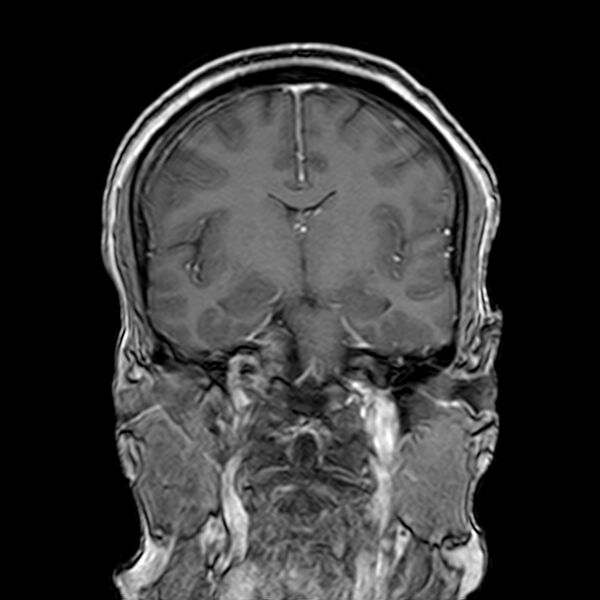File:Neurofibromatosis type 2 (Radiopaedia 67470-76871 Coronal T1 C+ 13).jpg