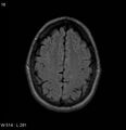 Neurosarcoidosis (Radiopaedia 10930-17204 Axial FLAIR 16).jpg