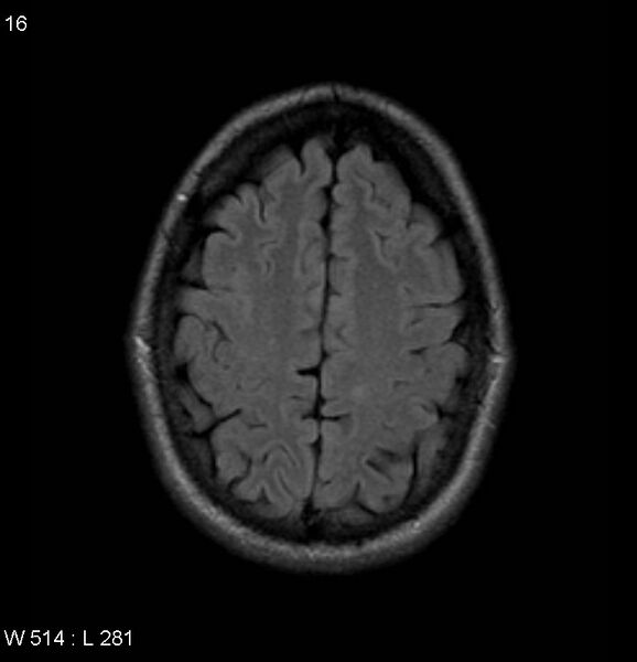 File:Neurosarcoidosis (Radiopaedia 10930-17204 Axial FLAIR 16).jpg