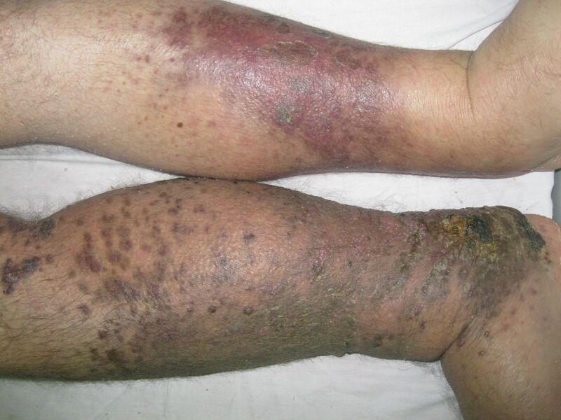 File:Non-AIDS associated Kaposi's sarcoma skin lesions (Radiopaedia 21810-21767 B 1).JPG