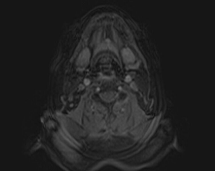 File:Non-Hodgkin lymphoma - parotid gland (Radiopaedia 71531-81890 E 26).jpg