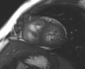 Non-compaction of the left ventricle (Radiopaedia 69436-79314 Short axis cine 85).jpg