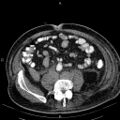 Non Hodgkin lymphoma in a patient with ankylosing spondylitis (Radiopaedia 84323-99621 Axial non-contrast 45).jpg