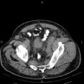 Non Hodgkin lymphoma in a patient with ankylosing spondylitis (Radiopaedia 84323-99621 Axial non-contrast 55).jpg