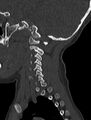 Normal CT cervical spine - pediatric (Radiopaedia 52549-58462 Sagittal bone window 169).jpg