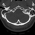 Normal CT of the cervical spine (Radiopaedia 53322-59305 Axial bone window 30).jpg