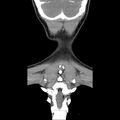 Normal CT of the neck (Radiopaedia 14575-14500 Coronal C+ 47).jpg