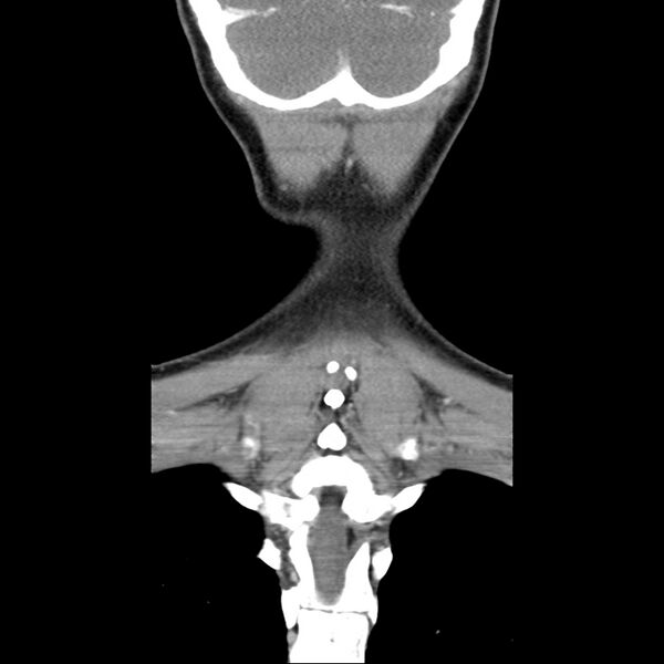 File:Normal CT of the neck (Radiopaedia 14575-14500 Coronal C+ 47).jpg