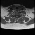 Normal cervical and thoracic spine MRI (Radiopaedia 35630-37156 Axial T1 10).png