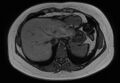 Normal liver MRI with Gadolinium (Radiopaedia 58913-66163 B 27).jpg