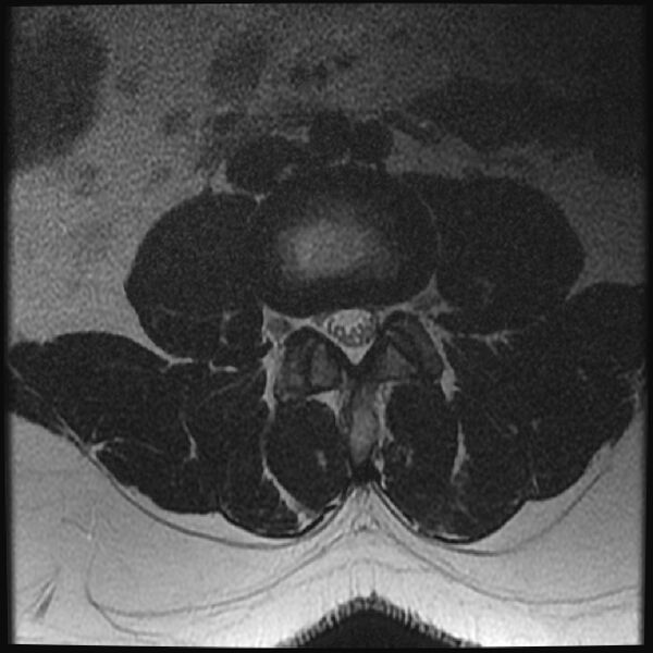 File:Normal lumbar spine MRI (Radiopaedia 43051-46311 Axial T2 14).jpg