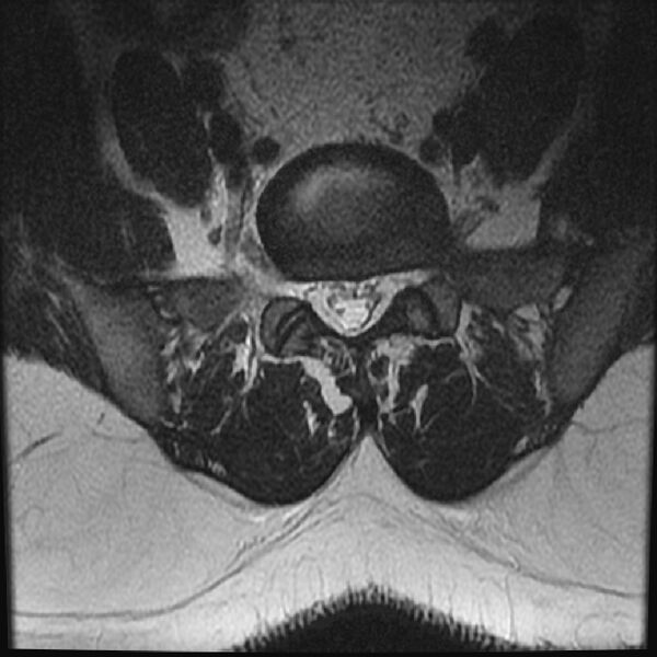 File:Normal lumbar spine MRI (Radiopaedia 43051-46311 Axial T2 24).jpg