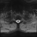 Normal trauma cervical spine (Radiopaedia 41017-43762 Axial T2 29).png