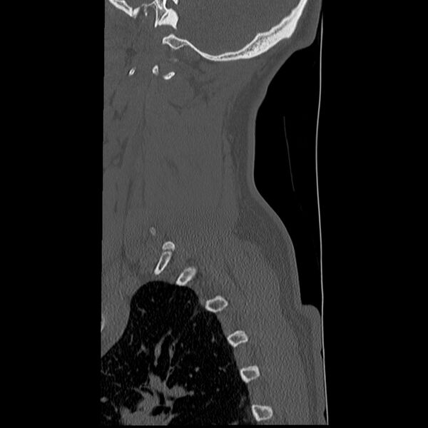 File:Normal trauma spine imaging (Radiopaedia 31753-32686 Sagittal bone window 3).jpg
