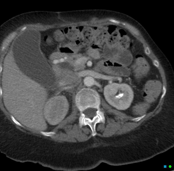 File:Obstructed infected horseshoe kidney (Radiopaedia 18116-17898 B 4).jpg