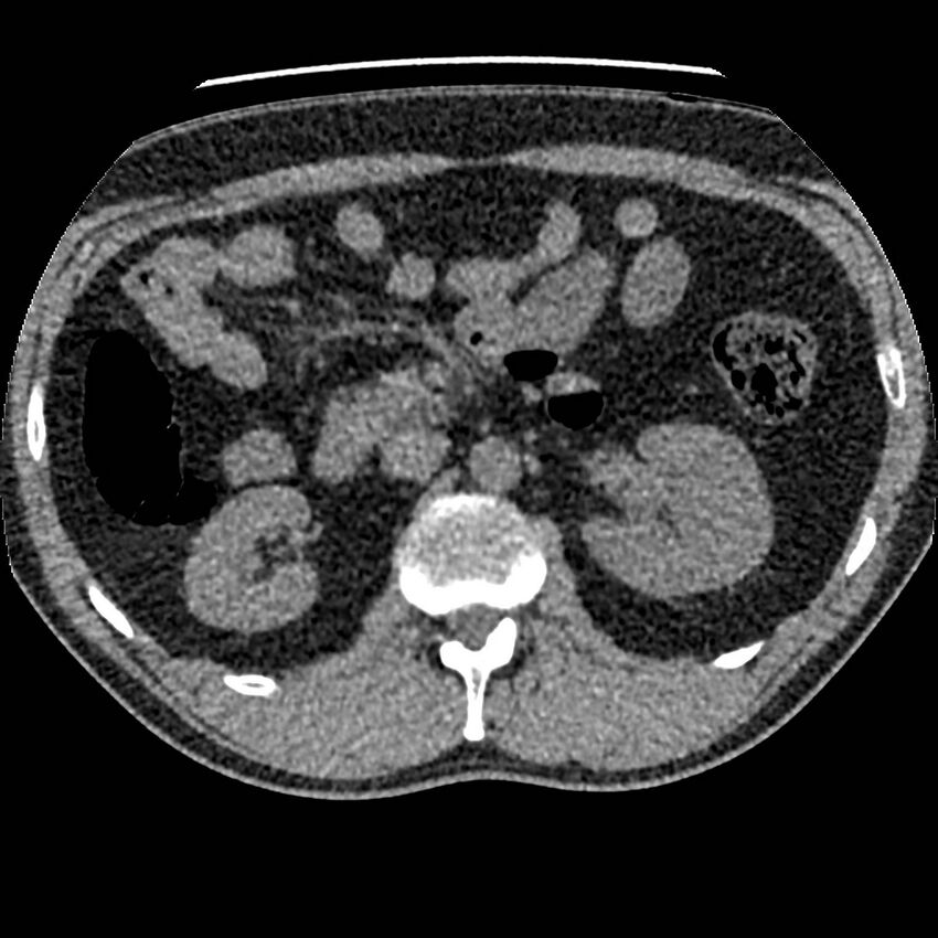 Obstructing ureteric calculus and ureteric anatomy (Radiopaedia 62730-71042 Axial non-contrast 37).jpg