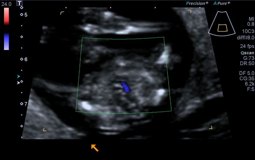 1st trimester nuchal-morphology ultrasound (Radiopaedia 44706-48477 Heart views cine with colour 204).jpg