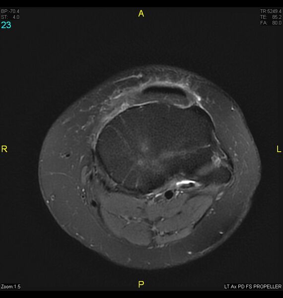 File:ACL mucoid degeration with cystic changes (Radiopaedia 48428-53341 Axial PD fat sat 20).jpg