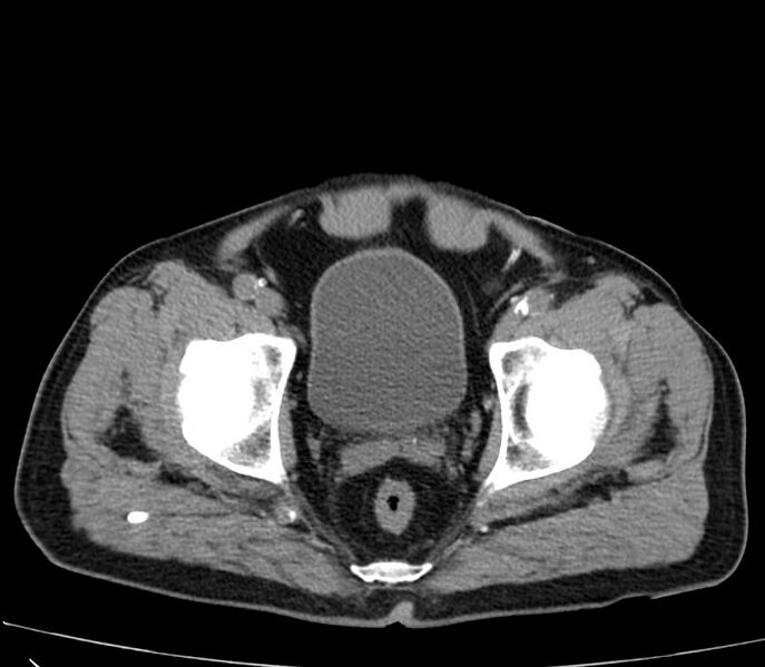 File:Abdominal aortic aneurysm (Radiopaedia 22421-22458 non-contrast 52).jpg