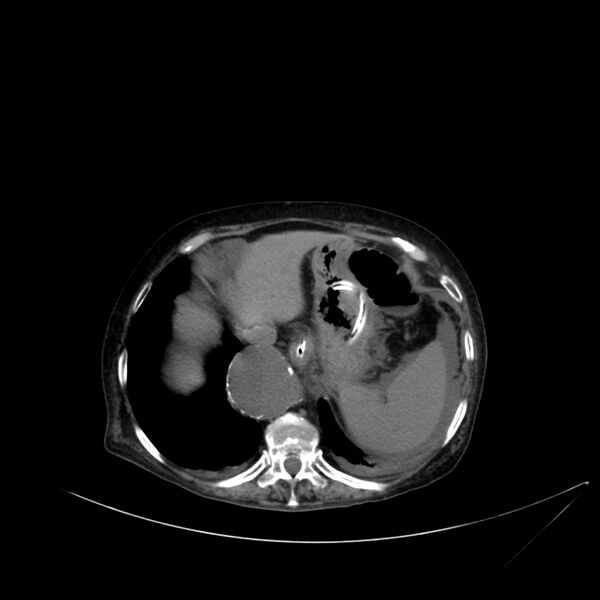 File:Abdominal aortic aneurysm - impending rupture (Radiopaedia 19233-19246 Axial non-contrast 24).jpg