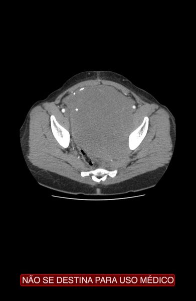 File:Abdominal desmoid tumor (Radiopaedia 44024-47540 Axial C+ arterial phase 42).jpg