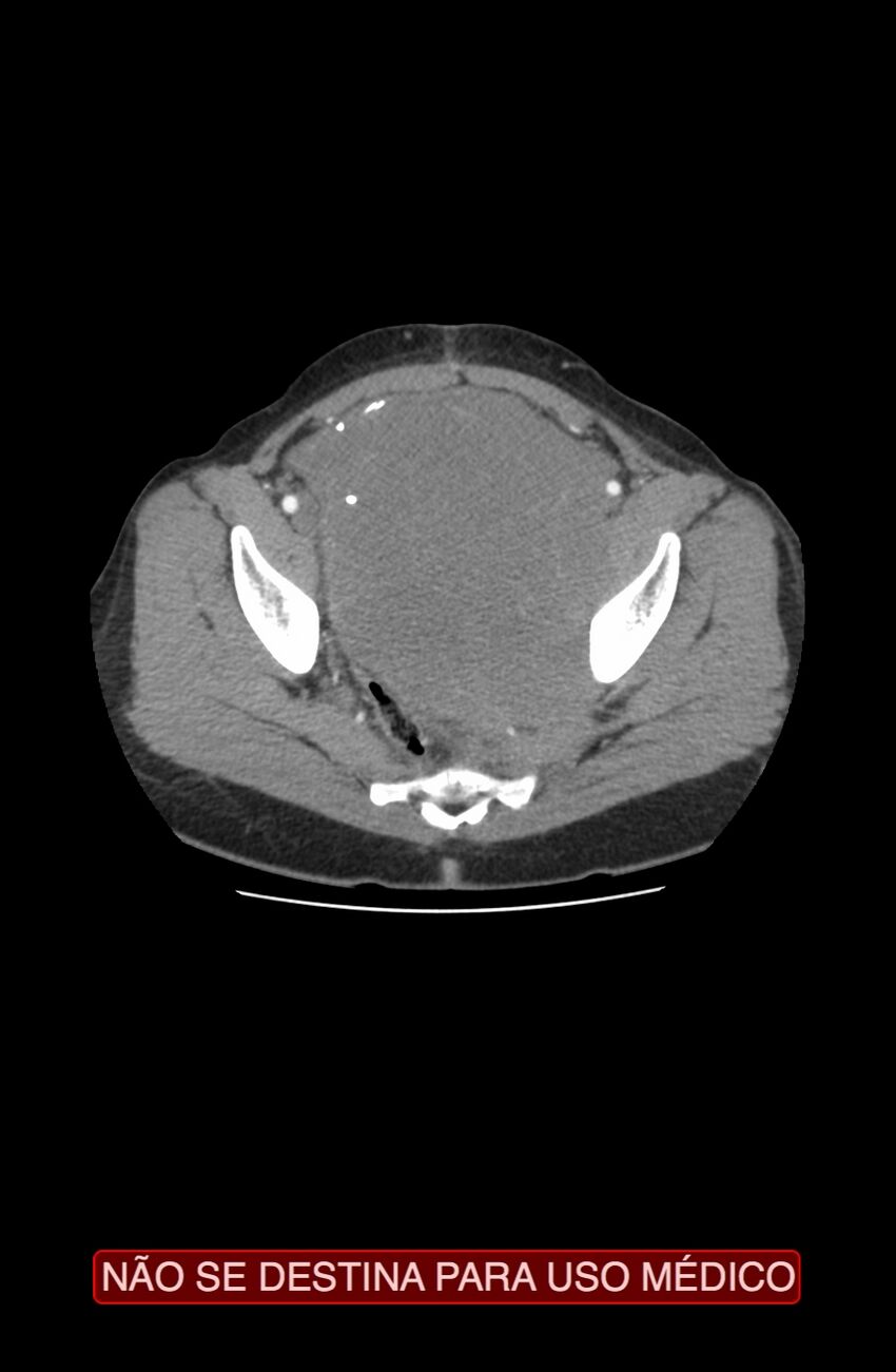 Abdominal desmoid tumor (Radiopaedia 44024-47540 Axial C+ arterial phase 42).jpg
