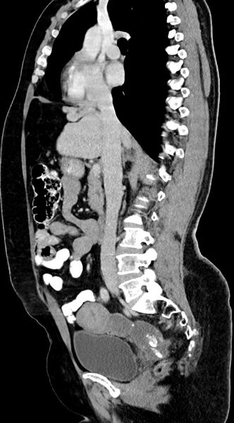 File:Abdominal hydatid disease (Radiopaedia 68223-77737 Sagittal C+ portal venous phase 40).jpg