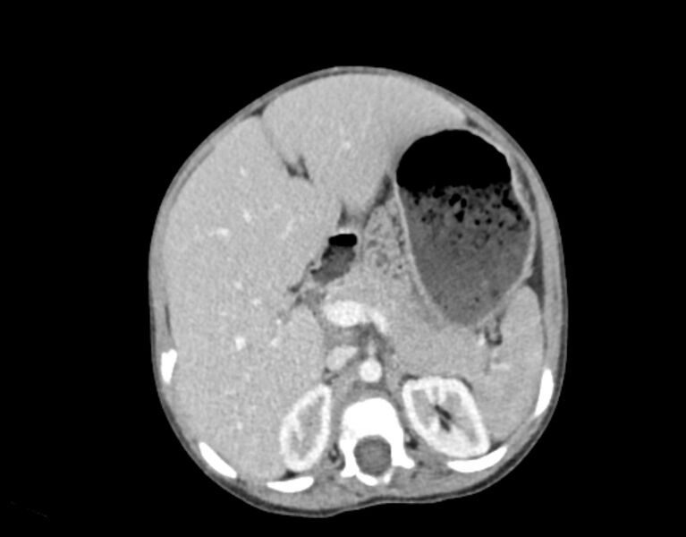 File:Abdominal premesenteric cystic lymphangioma (Radiopaedia 82995-97350 Axial C+ portal venous phase 17).jpg