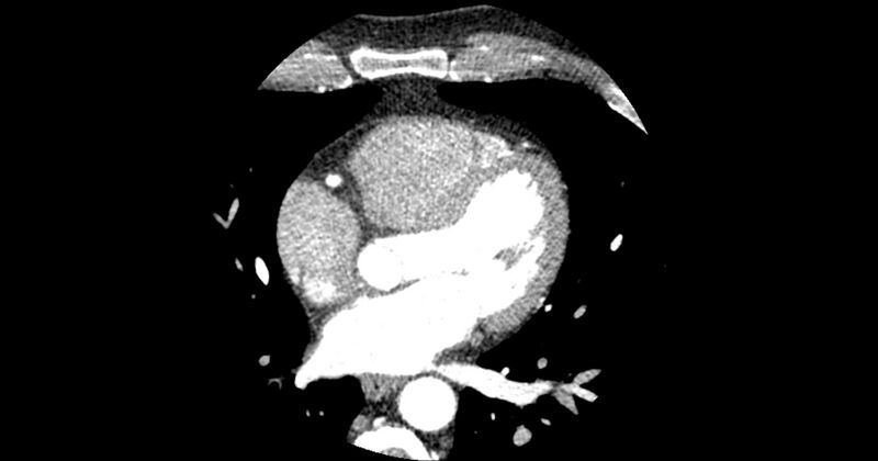 File:Aberrant left main coronary artery (ALMCA) arising from the right sinus with interarterial course (Radiopaedia 63251-71814 Axial C+ arterial phase 93).JPG