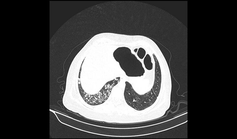 File:Acquired tracheo-esophageal fistula (Radiopaedia 51356-57103 Axial lung window 36).jpg