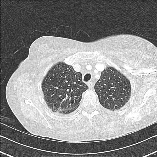 File:Acute-on-chronic pulmonary emboli (Radiopaedia 27925-28169 lung window 10).jpg