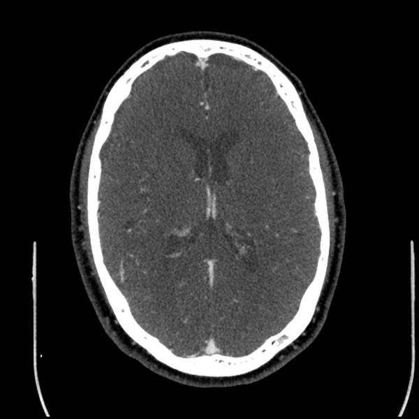 File:Acute A3 occlusion with ACA ischemic penumbra (CT perfusion) (Radiopaedia 72036-82527 Axial C+ arterial phase thins 52).jpg