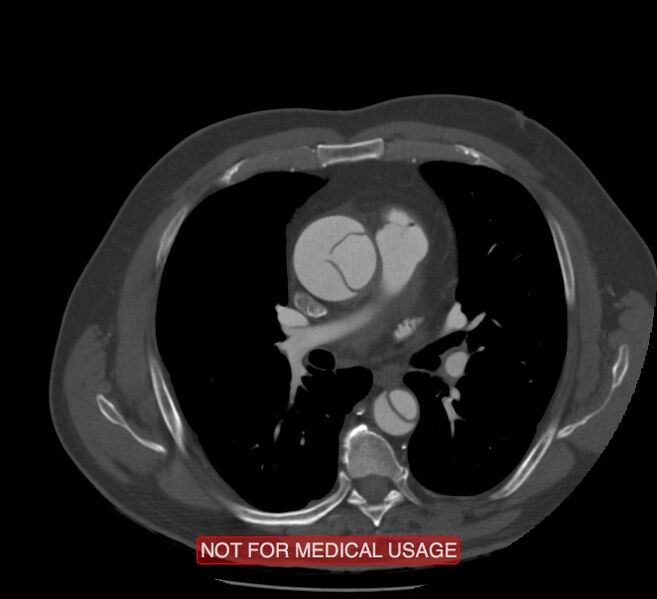 File:Acute aortic dissection - Stanford type A (Radiopaedia 40661-43285 Axial C+ arterial phase 28).jpg