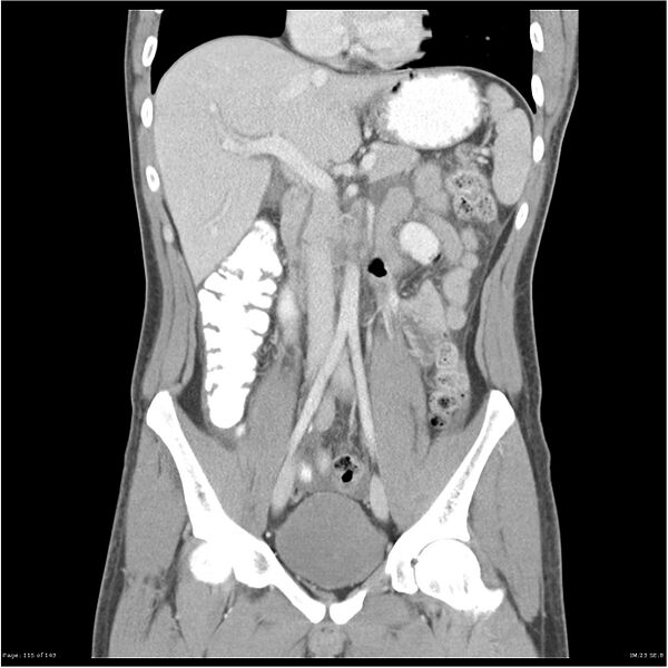 File:Acute appendicitis (Radiopaedia 25364-25615 C+ portal venous phase 12).jpg
