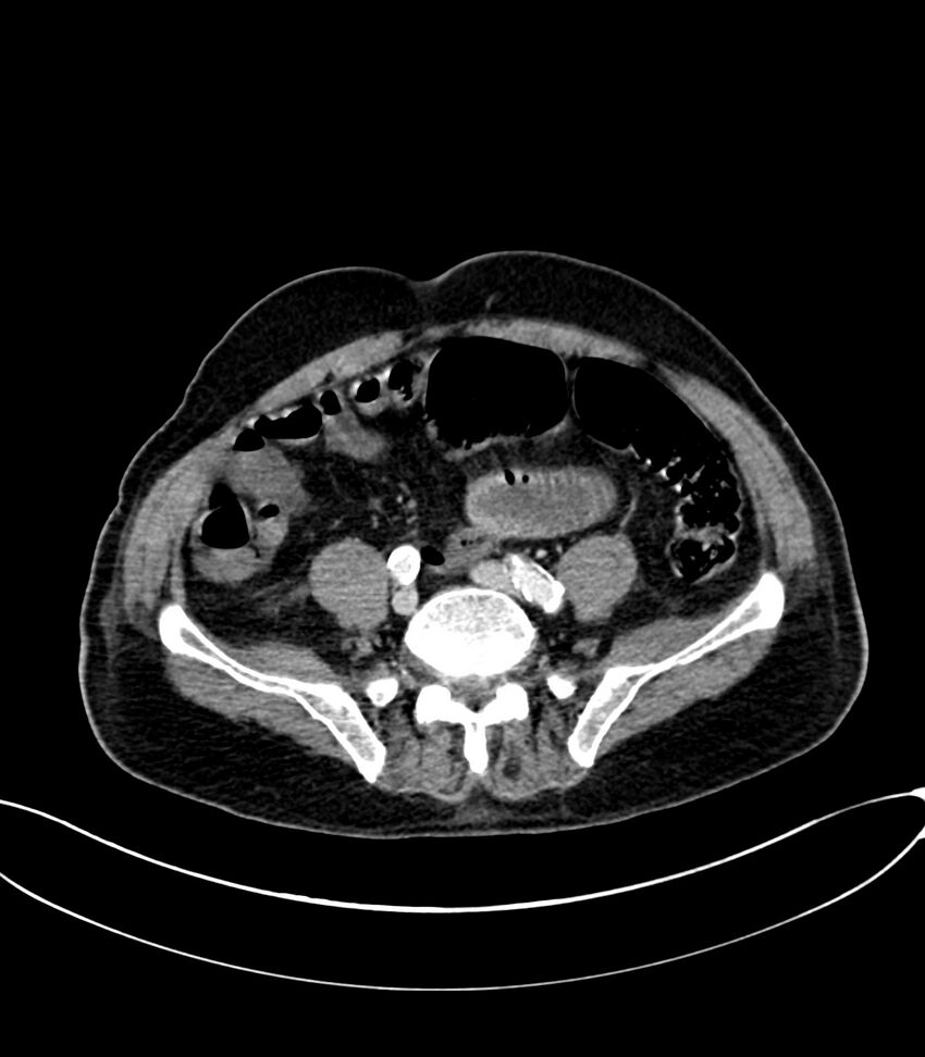 Acute arterial mesenteric ischemia (Radiopaedia 78238-90828 Axial C+ portal venous phase 99).jpg