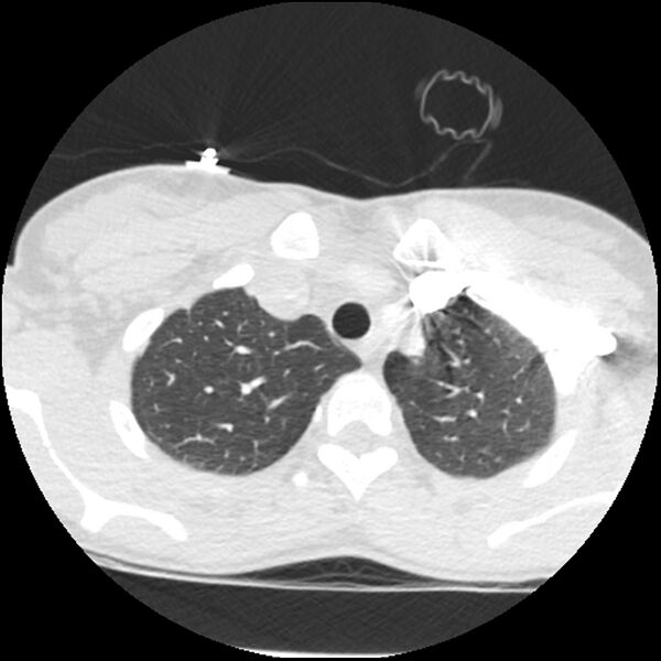 File:Acute chest syndrome - sickle cell disease (Radiopaedia 42375-45499 Axial lung window 38).jpg