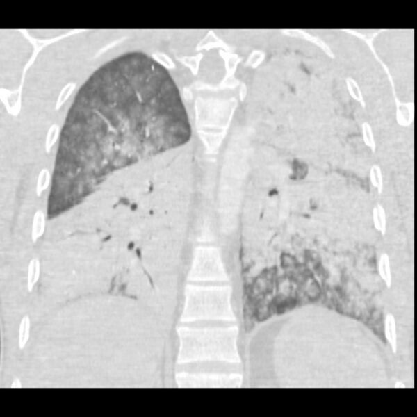 File:Acute diffuse alveolar hemorrhage (Radiopaedia 41323-44158 Coronal lung window 39).jpg