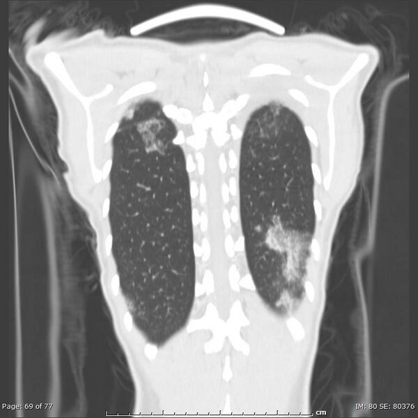 File:Acute eosinophilic pneumonia (Radiopaedia 48211-53073 Coronal 42).jpg