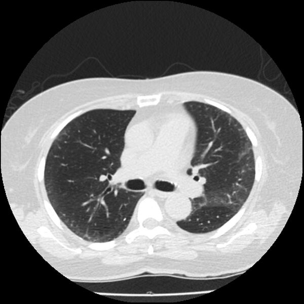 File:Acute interstitial pneumonitis (Radiopaedia 45404-49444 Axial lung window 46).jpg