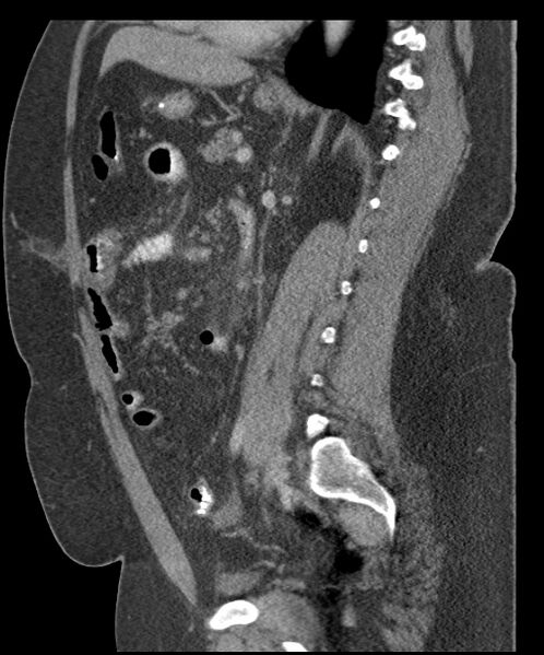 File:Acute mesenteric venous ischemia (Radiopaedia 46041-50383 Sagittal C+ portal venous phase 69).jpg