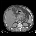 Acute pancreatitis (Radiopaedia 19135-19116 Axial non-contrast 12).jpg