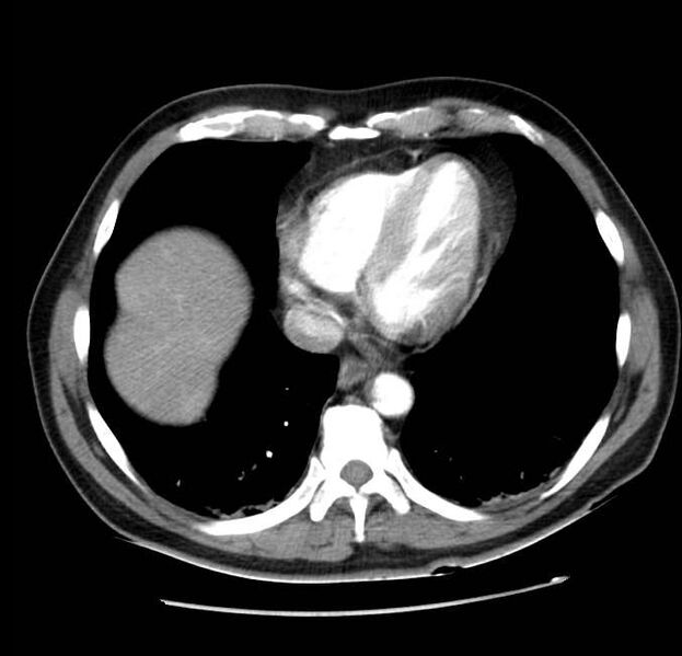 File:Acute pancreatitis - Balthazar E (Radiopaedia 23080-23110 Axial C+ arterial phase 4).jpg