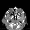 Acute parotitis (Radiopaedia 54123-60294 Axial C+ arterial phase 8).jpg