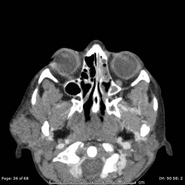 File:Acute parotitis (Radiopaedia 54123-60294 Axial C+ arterial phase 8).jpg
