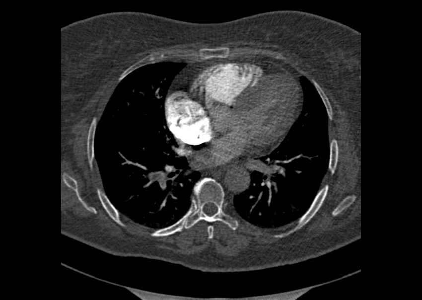 Acute pulmonary embolism (Radiopaedia 29938-30466 Axial C+ CTPA 119).jpg