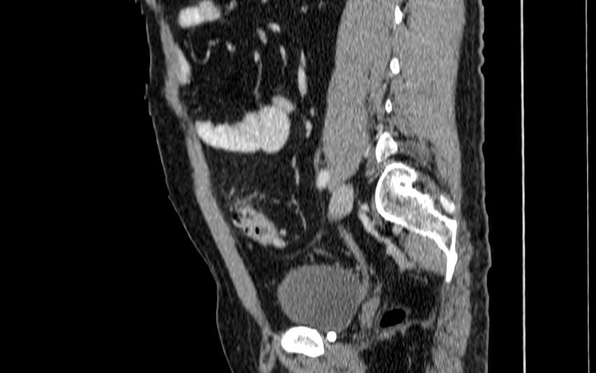 Acute sigmoid colon diverticulitis (Radiopaedia 55507-61976 Sagittal C+ portal venous phase 38).jpg