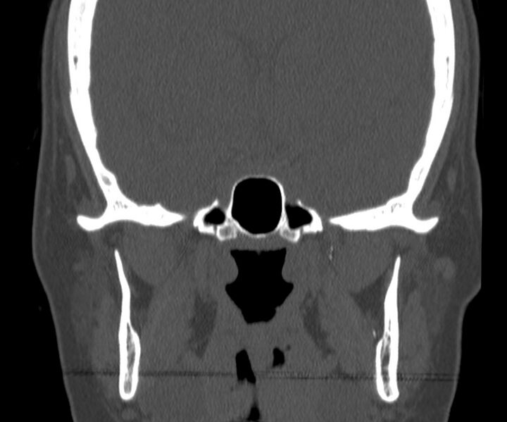 File:Acute sinusitis (Radiopaedia 22419-22455 Coronal bone window 35).jpg